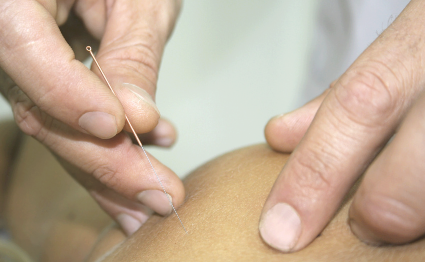 Demonstration of acupuncture